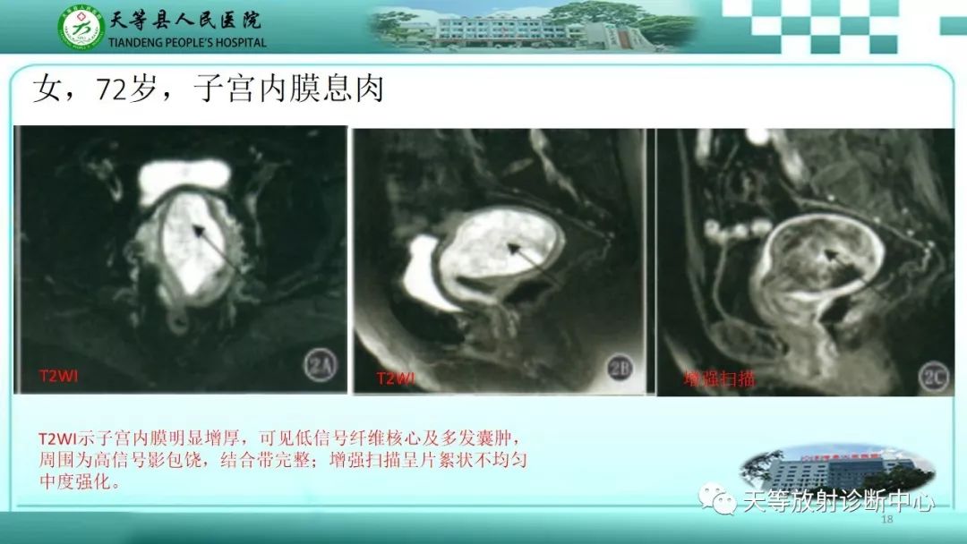 影像PPT - 【PPT】子宫内膜癌MRI诊断要点与鉴别诊断-18