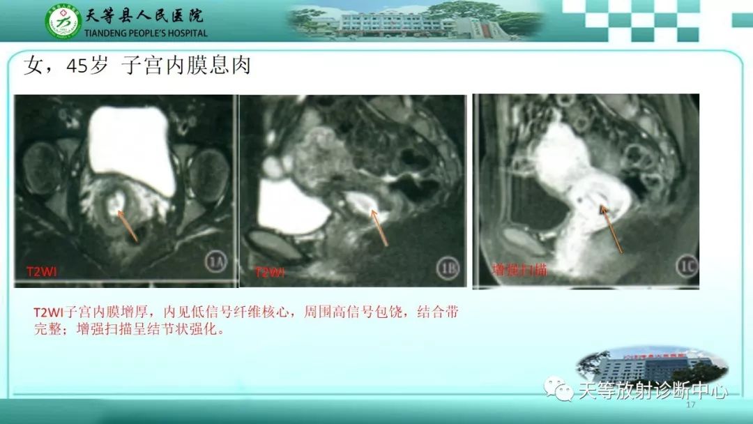 影像PPT - 【PPT】子宫内膜癌MRI诊断要点与鉴别诊断-17