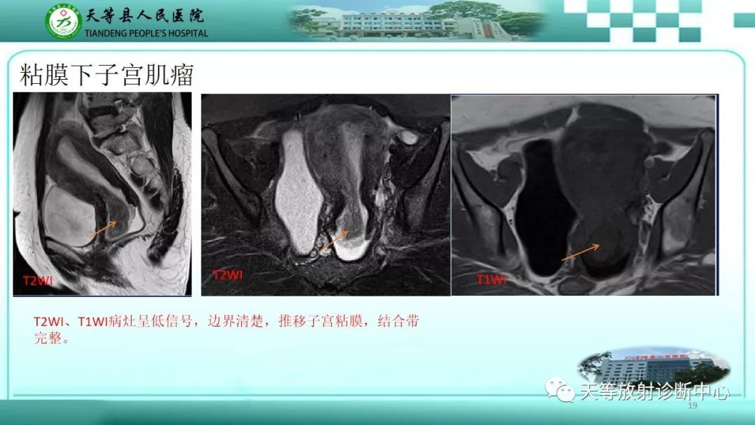 影像PPT - 【PPT】子宫内膜癌MRI诊断要点与鉴别诊断-19