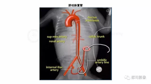 影像PPT - 【PPT】新生儿置管的影像学评价-4