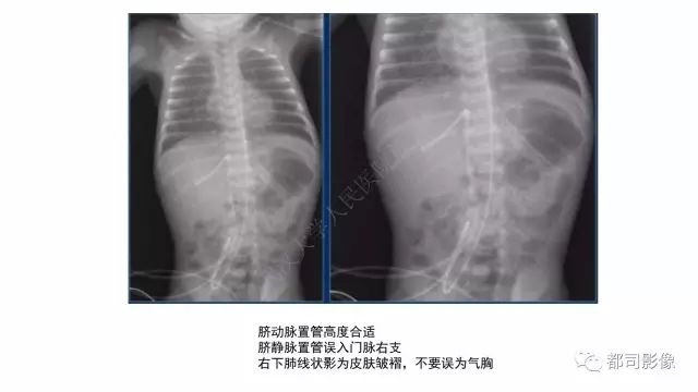 影像PPT - 【PPT】新生儿置管的影像学评价-5