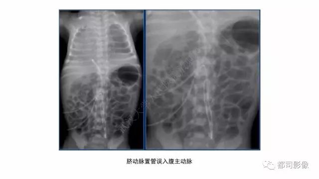 影像PPT - 【PPT】新生儿置管的影像学评价-6