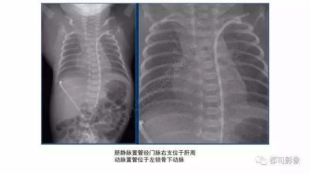 影像PPT - 【PPT】新生儿置管的影像学评价-11