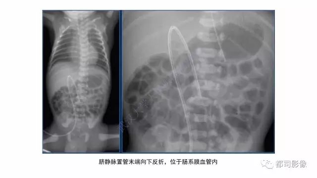 影像PPT - 【PPT】新生儿置管的影像学评价-14