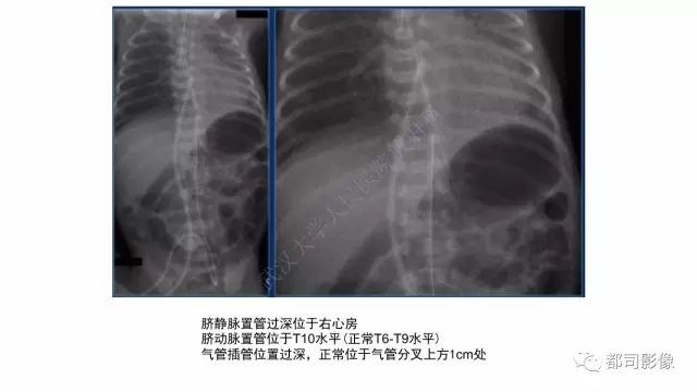 影像PPT - 【PPT】新生儿置管的影像学评价-15