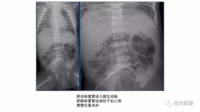 影像PPT - 【PPT】新生儿置管的影像学评价-8