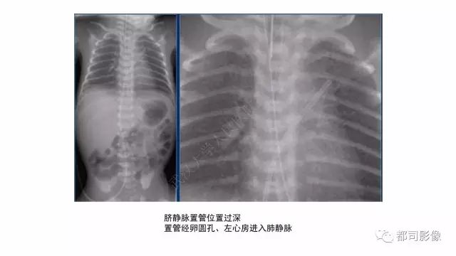 影像PPT - 【PPT】新生儿置管的影像学评价-16