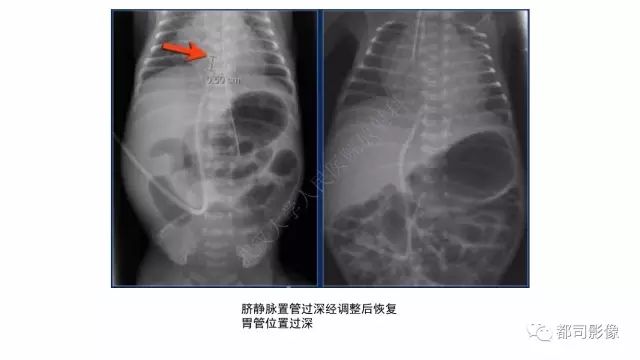 影像PPT - 【PPT】新生儿置管的影像学评价-18