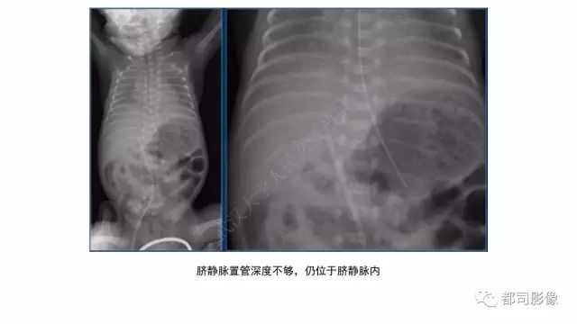 影像PPT - 【PPT】新生儿置管的影像学评价-13