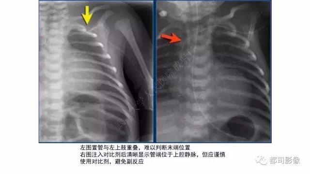 影像PPT - 【PPT】新生儿置管的影像学评价-20