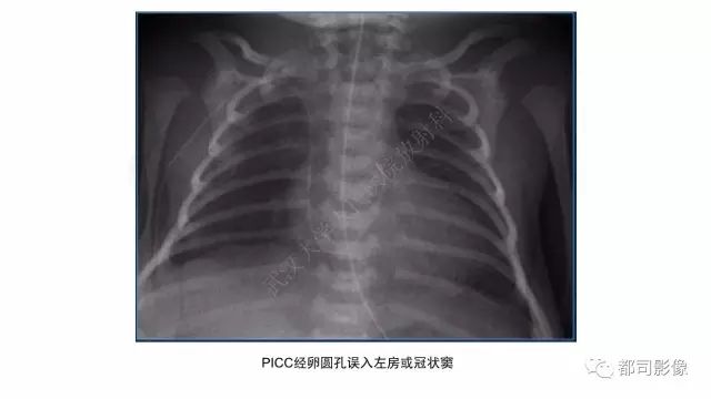 影像PPT - 【PPT】新生儿置管的影像学评价-22