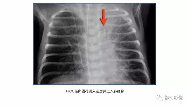 影像PPT - 【PPT】新生儿置管的影像学评价-23