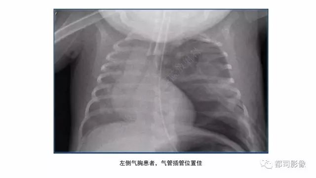 影像PPT - 【PPT】新生儿置管的影像学评价-25