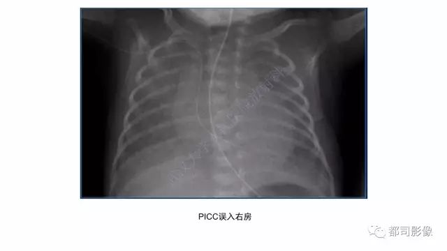 影像PPT - 【PPT】新生儿置管的影像学评价-21