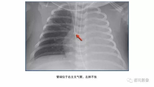 影像PPT - 【PPT】新生儿置管的影像学评价-26