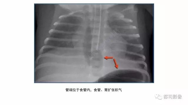 影像PPT - 【PPT】新生儿置管的影像学评价-27