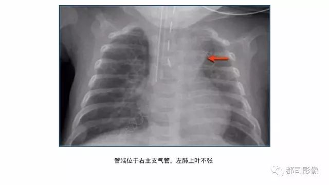 影像PPT - 【PPT】新生儿置管的影像学评价-28
