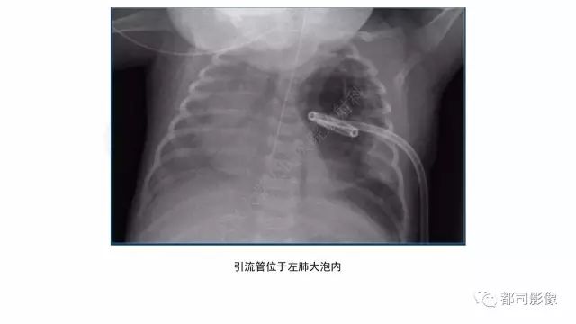 影像PPT - 【PPT】新生儿置管的影像学评价-31