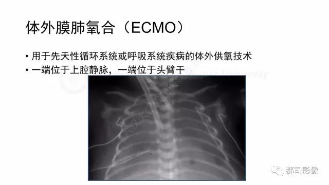 影像PPT - 【PPT】新生儿置管的影像学评价-35