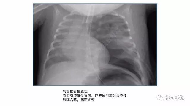 影像PPT - 【PPT】新生儿置管的影像学评价-30