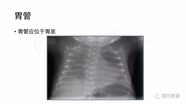 影像PPT - 【PPT】新生儿置管的影像学评价-32