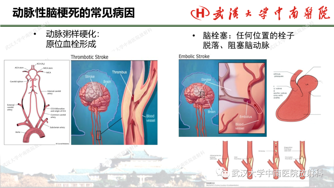 影像PPT - 【PPT】脑梗死的影像学表现-2