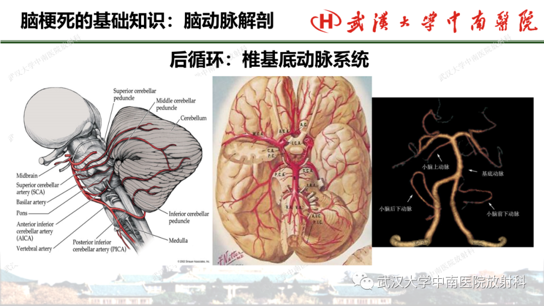 影像PPT - 【PPT】脑梗死的影像学表现-14