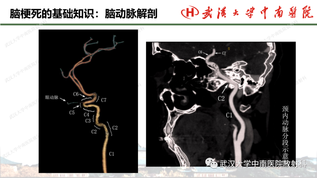 影像PPT - 【PPT】脑梗死的影像学表现-7