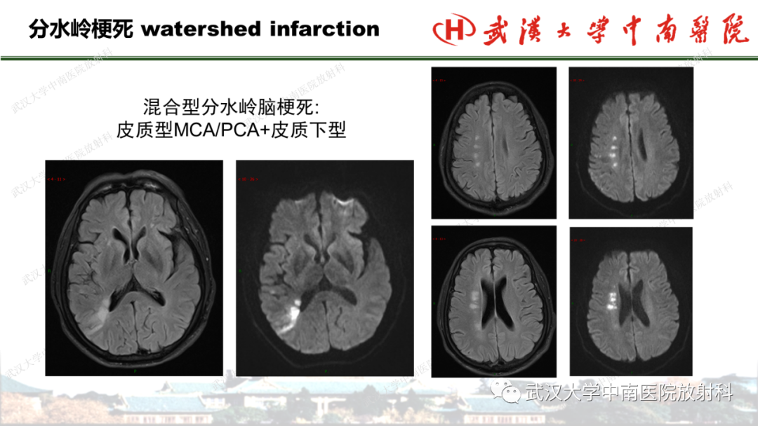 影像PPT - 【PPT】脑梗死的影像学表现-40