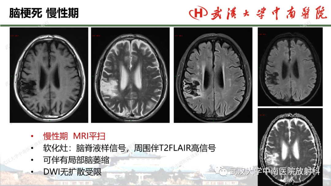 影像PPT - 【PPT】脑梗死的影像学表现-38