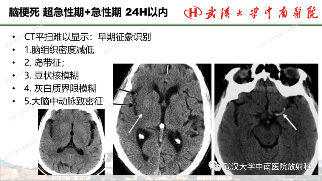 影像PPT - 【PPT】脑梗死的影像学表现-23