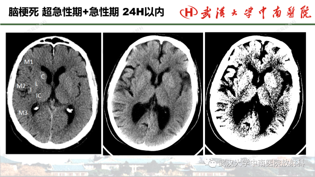 影像PPT - 【PPT】脑梗死的影像学表现-24