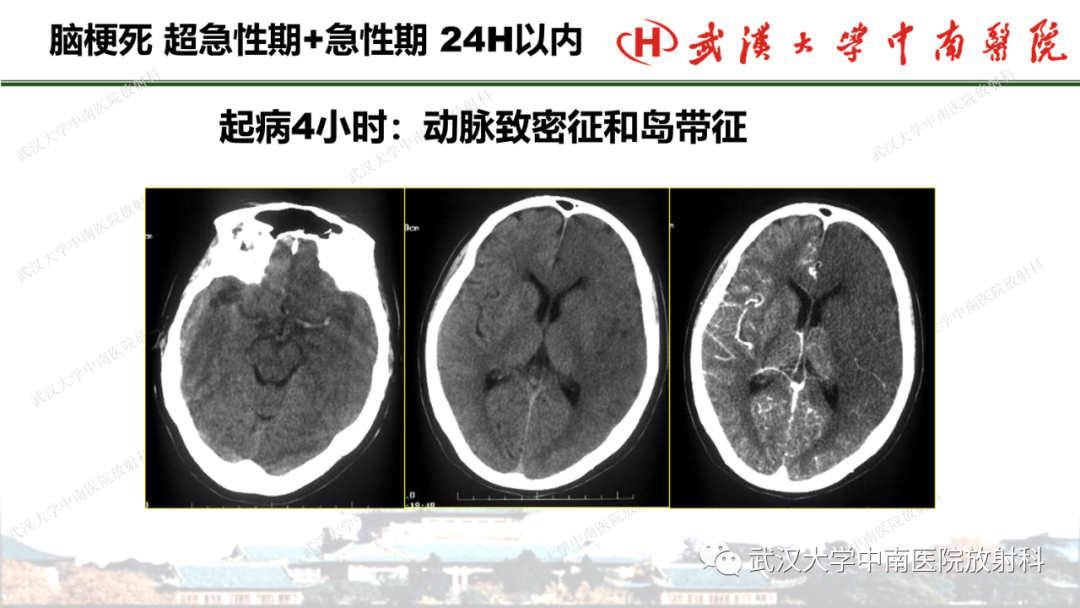 影像PPT - 【PPT】脑梗死的影像学表现-26