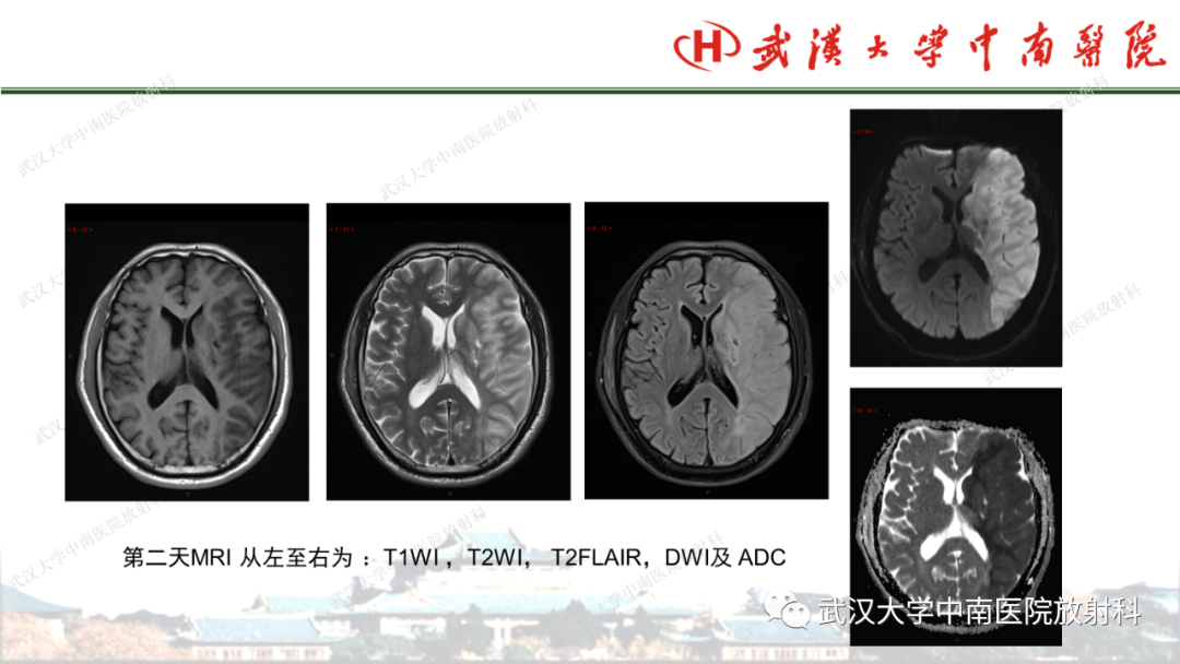 影像PPT - 【PPT】脑梗死的影像学表现-35