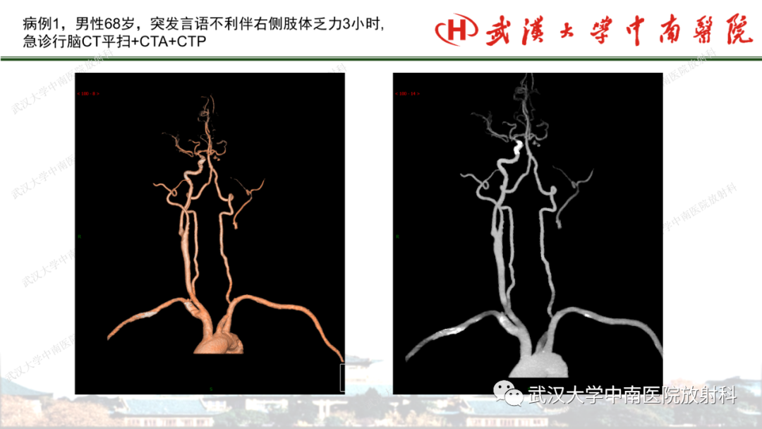 影像PPT - 【PPT】脑梗死的影像学表现-34