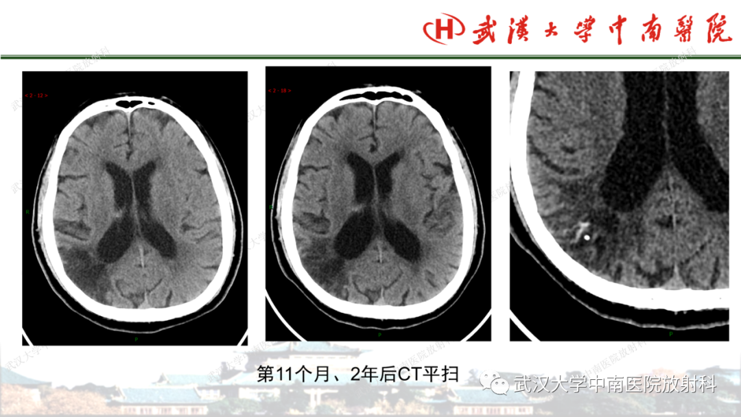 影像PPT - 【PPT】脑梗死的影像学表现-48