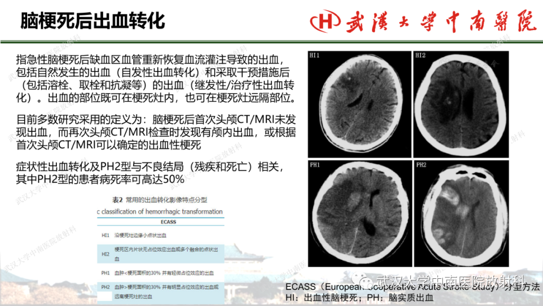 影像PPT - 【PPT】脑梗死的影像学表现-42