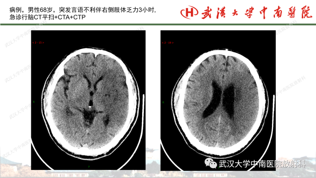影像PPT - 【PPT】脑梗死的影像学表现-32
