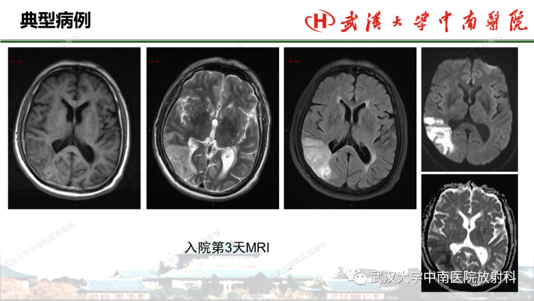影像PPT - 【PPT】脑梗死的影像学表现-44