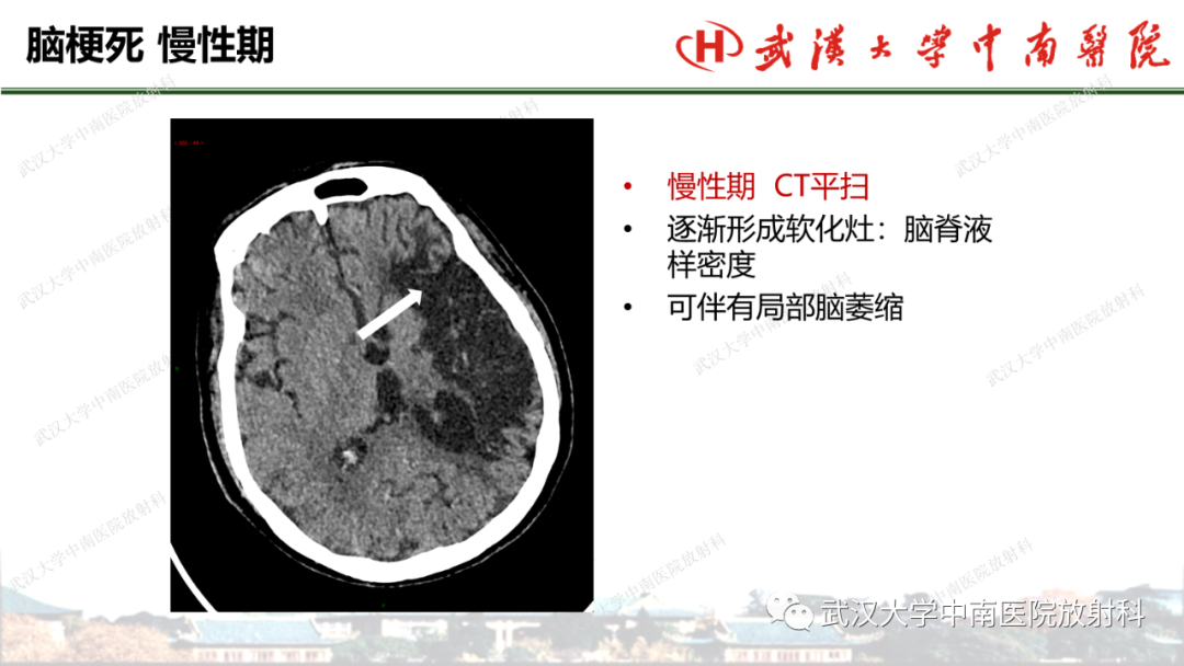 影像PPT - 【PPT】脑梗死的影像学表现-37