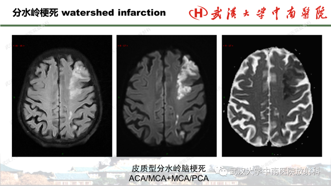 影像PPT - 【PPT】脑梗死的影像学表现-41