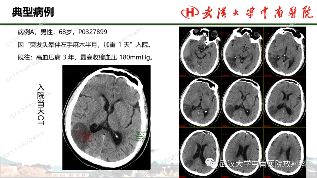 影像PPT - 【PPT】脑梗死的影像学表现-43