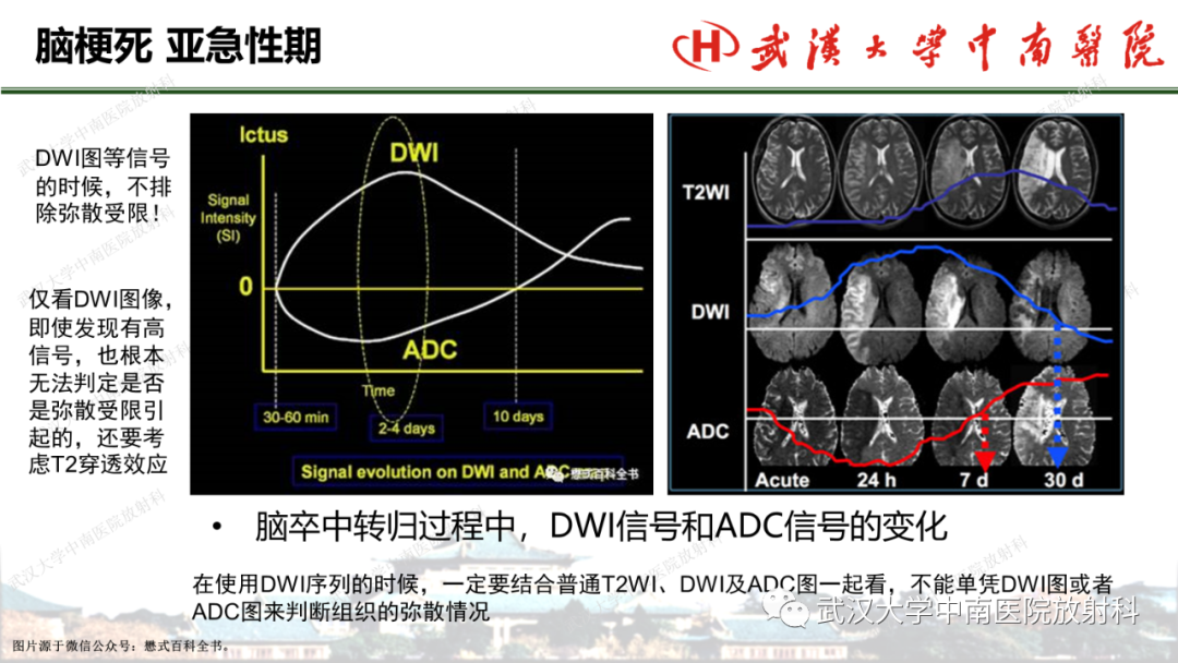 影像PPT - 【PPT】脑梗死的影像学表现-31