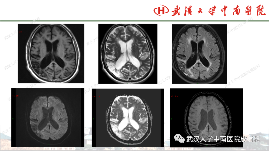影像PPT - 【PPT】脑梗死的影像学表现-49