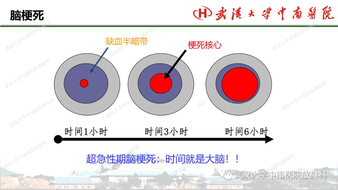 影像PPT - 【PPT】脑梗死的影像学表现-22