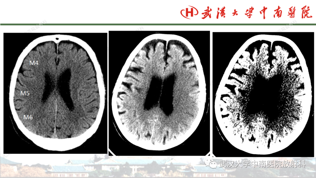 影像PPT - 【PPT】脑梗死的影像学表现-25