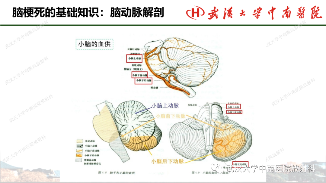 影像PPT - 【PPT】脑梗死的影像学表现-18