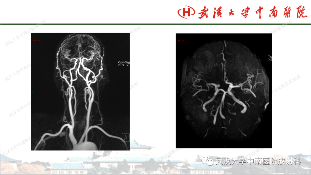 影像PPT - 【PPT】脑梗死的影像学表现-46