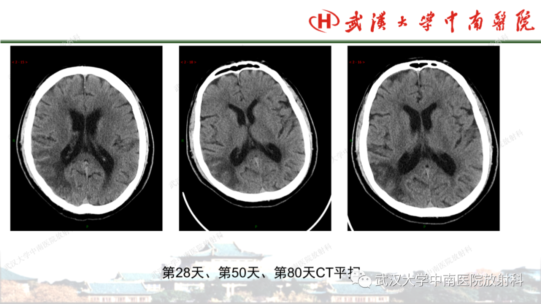 影像PPT - 【PPT】脑梗死的影像学表现-47
