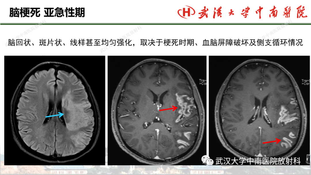 影像PPT - 【PPT】脑梗死的影像学表现-36